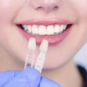 Улыбка мечты стала ближе — виниры за 35 000 ₽ вместо 45 000 ₽